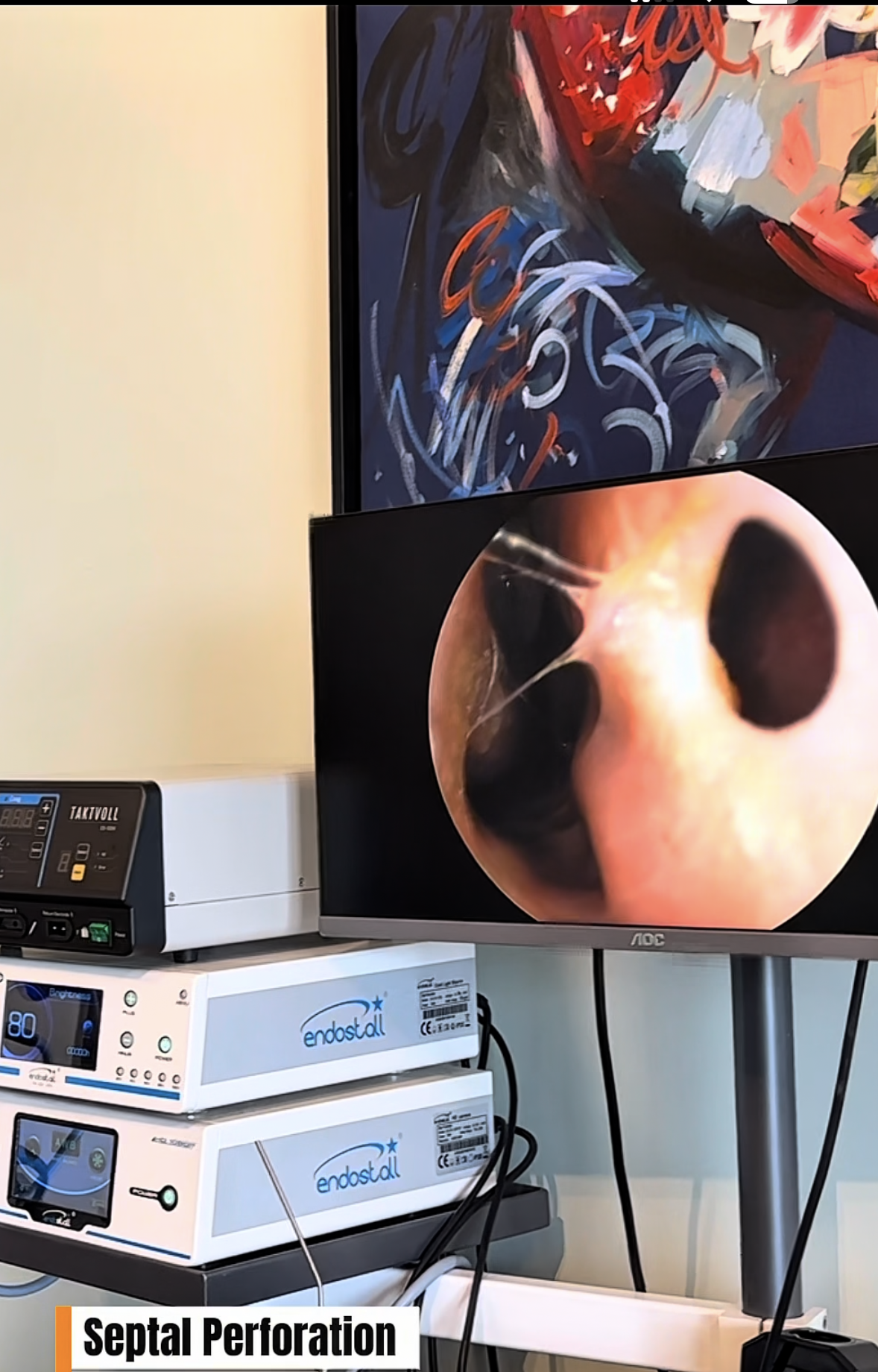 septal perforation dr erdal erkoc clinic